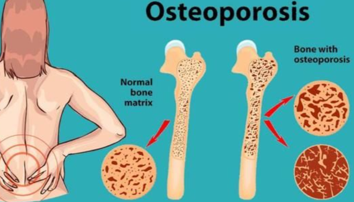 Penyakit Osteoporosis Terjadi Karena Hal Tak Terduga