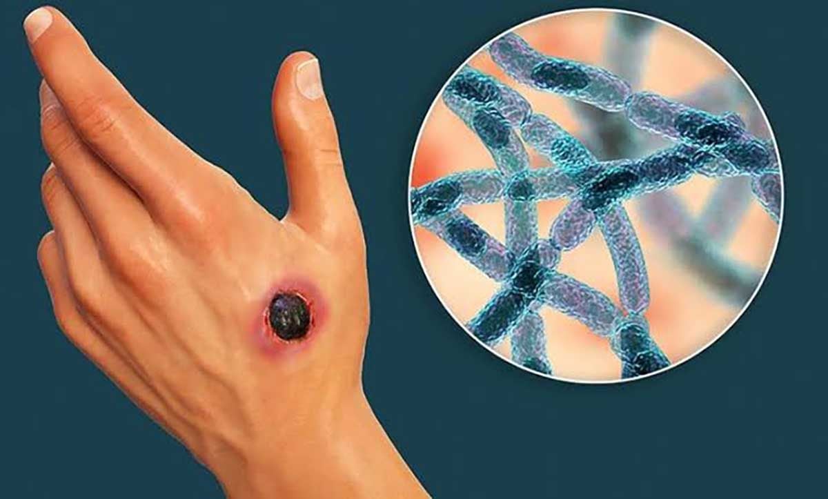 Penyakit Antraks, Bisa Mematikan Yang Harus Di Waspadai!