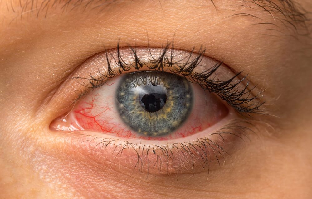 Fotokeratitis, Ketika Mata Terbakar Akibat Kena Sinar UV Berlebih