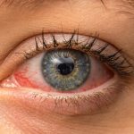 Fotokeratitis, Ketika Mata Terbakar Akibat Kena Sinar UV Berlebih