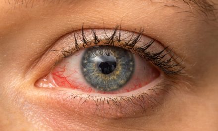 Fotokeratitis, Ketika Mata Terbakar Akibat Kena Sinar UV Berlebih