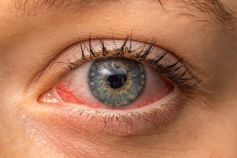 Fotokeratitis