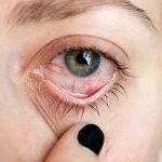Penyakit Uveitis Peradangan Yang Terjadi Pada Uvea