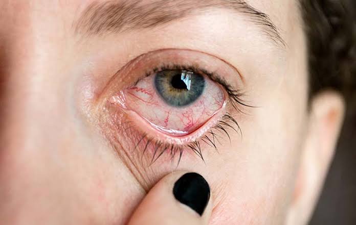 Penyakit Uveitis